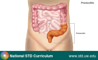 Diagnosis: Proctitis / Proctocolitis, Clinical Signs: Discharge / Anal, Locations: Abdomen, Symptoms: Painful, Image Type: Illustration