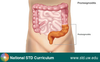 Diagnosis: Proctitis / Proctocolitis, Clinical Signs: N/A, Locations: Abdomen, Symptoms: Painful, Image Type: Illustration
