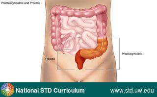 Diagnosis: Proctitis / Proctocolitis, Clinical Signs: N/A, Locations: Abdomen, Symptoms: Painful, Image Type: Photo