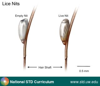 Diagnosis: Lice / Crabs, Clinical Signs: N/A, Locations: N/A, Symptoms: N/A, Image Type: Illustration