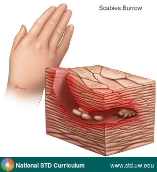 Diagnosis: Scabies, Clinical Signs: N/A, Locations: Hand (Right), Symptoms: Itch, Rash, Image Type: Illustration