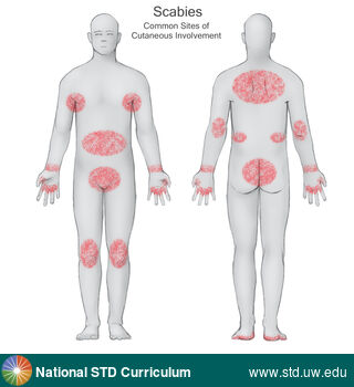 Diagnosis: Scabies, Clinical Signs: N/A, Locations: N/A, Symptoms: Itch, Rash, Image Type: Illustration