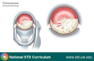 Diagnosis: Trichomoniasis, Clinical Signs: N/A, Locations: Cervix, Symptoms: Discharge, Image Type: Illustration