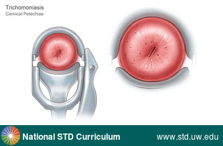 Diagnosis: Trichomoniasis, Clinical Signs: Petchiae, Locations: Cervix, Symptoms: N/A, Image Type: Illustration