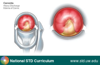 Diagnosis: Cervicitis, Clinical Signs: Discharge / Vagina / Cervix, Edema / Swelling, Locations: Cervix, Symptoms: Discharge, Image Type: Illustration