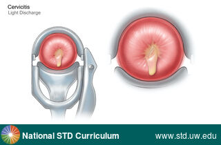 Diagnosis: Cervicitis, Clinical Signs: Discharge / Vagina / Cervix, Locations: Cervix, Symptoms: Discharge, Image Type: Illustration