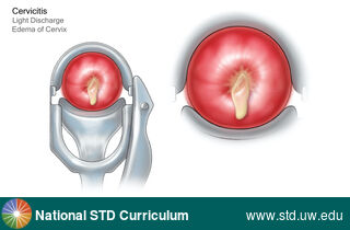 Diagnosis: Cervicitis, Clinical Signs: Discharge / Vagina / Cervix, Edema / Swelling, Locations: Cervix, Symptoms: Discharge, Image Type: Illustration