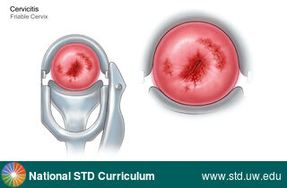 Diagnosis: Cervicitis, Clinical Signs: N/A, Locations: Cervix, Symptoms: N/A, Image Type: Illustration
