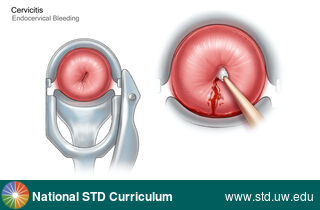 Diagnosis: Cervicitis, Clinical Signs: N/A, Locations: Cervix, Symptoms: N/A, Image Type: Illustration