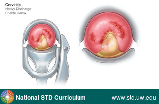 Diagnosis: Cervicitis, Clinical Signs: Discharge / Vagina / Cervix, Locations: Cervix, Symptoms: Discharge, Image Type: Illustration