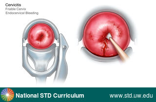 Diagnosis: Cervicitis, Clinical Signs: N/A, Locations: Cervix, Symptoms: N/A, Image Type: Illustration