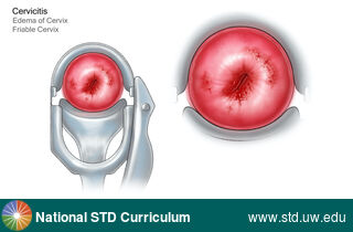 Diagnosis: Cervicitis, Clinical Signs: Edema / Swelling, Locations: Cervix, Symptoms: N/A, Image Type: Illustration