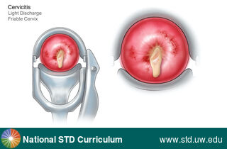 Diagnosis: Cervicitis, Clinical Signs: Discharge / Vagina / Cervix, Locations: Cervix, Symptoms: N/A, Image Type: Illustration