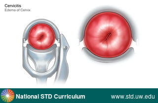 Diagnosis: Cervicitis, Clinical Signs: Edema / Swelling, Locations: N/A, Symptoms: N/A, Image Type: Illustration