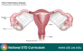 Diagnosis: Chlamydia, Clinical Signs: N/A, Locations: Female Genitourinary, Symptoms: N/A, Image Type: Illustration