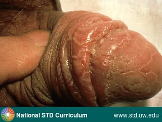 Diagnosis: Reiter's Syndrome, Clinical Signs: Patch/Patches, Locations: Penis, Symptoms: N/A, Image Type: Illustration