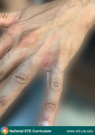 Diagnosis: Mpox, Clinical Signs: Pustule / Pustules, Locations: Hand (Left), Symptoms: N/A, Image Type: Photo