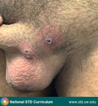 Diagnosis: Mpox, Clinical Signs: Erythema, Pustule / Pustules, Ulcer / Ulcers, Locations: Light skin tone, Penis, Scrotum, Suprapubic (Hypogastrium), Symptoms: Painful, Image Type: Photo