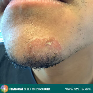 Diagnosis: Impetigo, Clinical Signs: Bulla / Bullae, Erythema, Locations: Face, Symptoms: Rash, Image Type: Photo