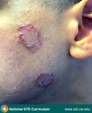 Diagnosis: Impetigo, Clinical Signs: Erythema, Hyperpigmentation, Patch/Patches, Scab, Locations: Face, Symptoms: Rash, Image Type: Photo