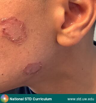 Diagnosis: Impetigo, Clinical Signs: Erythema, Hypopigmentation, Patch/Patches, Scab, Locations: Face, Symptoms: Rash, Image Type: Photo