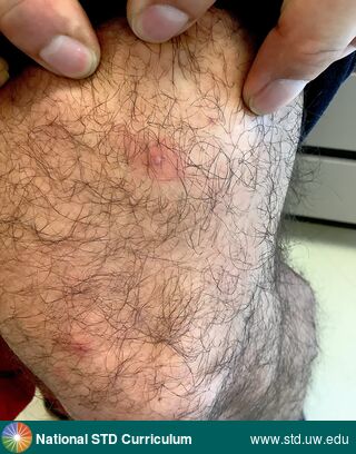 Diagnosis: Mpox, Clinical Signs: Papule / Papules, Pustule / Pustules, Locations: Light skin tone, Thigh, Symptoms: N/A, Image Type: Photo