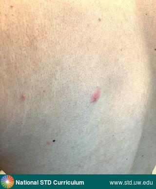 Diagnosis: Mpox, Clinical Signs: Papule / Papules, Pustule / Pustules, Locations: Back, Light skin tone, Symptoms: Non-Painful, Image Type: Photo