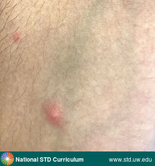 Diagnosis: Mpox, Clinical Signs: Papule / Papules, Pustule / Pustules, Locations: Arm (Right), Light skin tone, Symptoms: Painful, Image Type: Photo