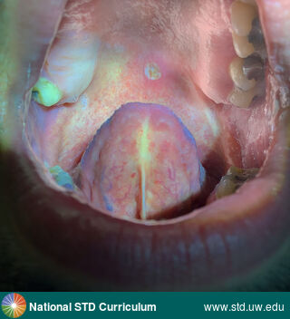 Diagnosis: Mpox, Clinical Signs: Ulcer / Ulcers, Locations: Light skin tone, Palate, Symptoms: Painful, Image Type: Photo