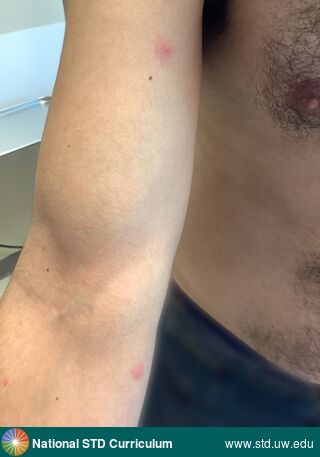 Diagnosis: Mpox, Clinical Signs: Papule / Papules, Pustule / Pustules, Locations: Arm (Right), Symptoms: Non-Painful, Image Type: Photo