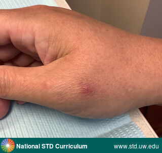 Diagnosis: Mpox, Clinical Signs: Erythema, Papule / Papules, Scab, Locations: Hand (Left), Symptoms: Painful, Image Type: Photo