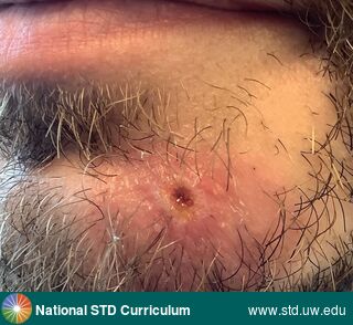 Diagnosis: Mpox, Clinical Signs: Pustule / Pustules, Scab, Ulcer / Ulcers, Locations: Face, Symptoms: N/A, Image Type: Photo