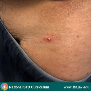 Diagnosis: Mpox, Clinical Signs: Erythema, Pustule / Pustules, Locations: Back, Symptoms: N/A, Image Type: Photo