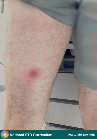Diagnosis: Mpox, Clinical Signs: Edema / Swelling, Erythema, Locations: Thigh, Symptoms: Painful, Image Type: Photo