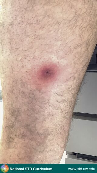 Diagnosis: Mpox, Clinical Signs: Edema / Swelling, Erythema, Locations: Thigh, Symptoms: Painful, Image Type: Photo