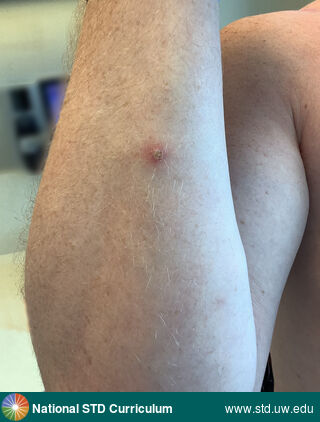 Diagnosis: Mpox, Clinical Signs: Erythema, Pustule / Pustules, Locations: Arm (Right), Symptoms: N/A, Image Type: Photo