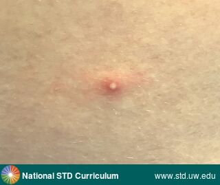 Diagnosis: Mpox, Clinical Signs: Erythema, Pustule / Pustules, Locations: Abdomen, Symptoms: N/A, Image Type: Photo