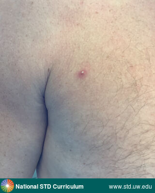Diagnosis: Mpox, Clinical Signs: Erythema, Pustule / Pustules, Locations: Chest, Shoulder (Right), Symptoms: N/A, Image Type: Photo