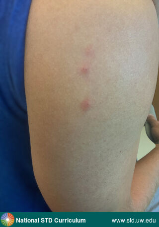 Diagnosis: Mpox, Clinical Signs: Erythema, Papule / Papules, Locations: Arm (Right), Symptoms: Itch, Image Type: Photo