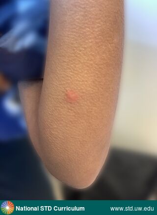 Diagnosis: Mpox, Clinical Signs: Erythema, Papule / Papules, Locations: Arm (Left), Symptoms: N/A, Image Type: Photo