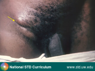 Diagnosis: Lymphogranuloma venereum, Clinical Signs: Edema / Swelling, Nodule / Nodules, Locations: Dark skin tone, Groin/Inguinal, Symptoms: N/A, Image Type: Photo