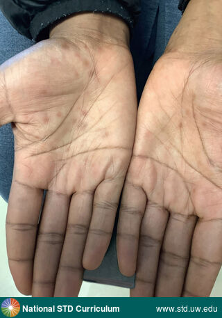 Diagnosis: Syphilis-Secondary, Clinical Signs: Hyperpigmentation, Macule / Macules, Locations: Dark skin tone, Hand (Left), Hand (Right), Symptoms: Rash, Image Type: Photo