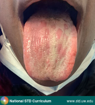 Diagnosis: Syphilis-Secondary, Clinical Signs: Patch/Patches, Ulcer / Ulcers, Locations: Dark skin tone, Tongue, Symptoms: N/A, Image Type: Photo