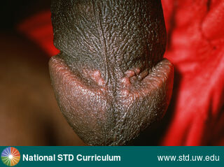 Diagnosis: Tyson's glands, Clinical Signs: Papule / Papules, Locations: Penis, Symptoms: N/A, Image Type: Photo