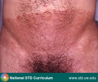 Diagnosis: Tinea cruris, Clinical Signs: Erythema, Hyperpigmentation, Rash, Locations: Groin/Inguinal, Light skin tone, Suprapubic (Hypogastrium), Symptoms: N/A, Image Type: Photo