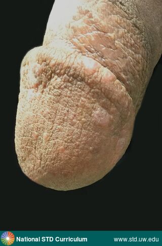 Diagnosis: Lichen planus, Clinical Signs: Hypopigmentation, Plaque, Locations: Penis, Symptoms: Non-Painful, Image Type: Photo