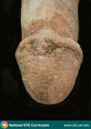Diagnosis: Lichen planus, Clinical Signs: Annular, Hypopigmentation, Plaque, Locations: Penis, Symptoms: Non-Painful, Image Type: Photo