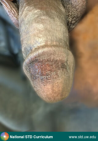 Diagnosis: Fixed Drug Eruption, Clinical Signs: Hyperpigmentation, Locations: Dark skin tone, Penis, Symptoms: Non-Painful, Image Type: Photo