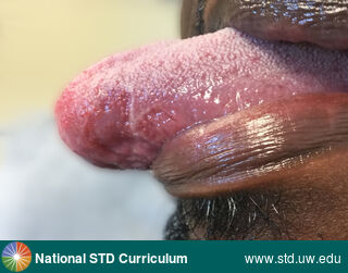 Diagnosis: Fixed Drug Eruption, Clinical Signs: Annular, Ulcer / Ulcers, Locations: Dark skin tone, Tongue, Symptoms: N/A, Image Type: Photo