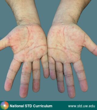 Diagnosis: Syphilis-Secondary, Clinical Signs: Erythema, Macule / Macules, Locations: Hand (Left), Hand (Right), Symptoms: Non-Itchy, Non-Painful, Rash, Image Type: Photo